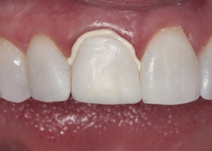 ExperTemp placement on tooth