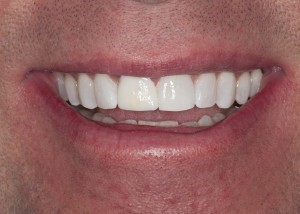 Teeth image ExperTemp