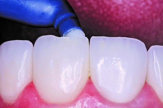 How To Repair Porcelain Restorations Instead Of Replacing Them