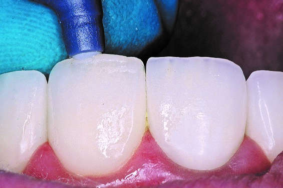 The final layer of composite is added to incisal edge repair