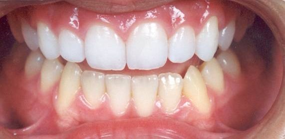 whitening results