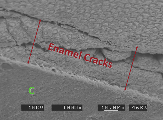 polymerization shrinkage can sometimes cause enamel cracks to form